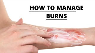 First Aid for Burns [upl. by Thorpe]