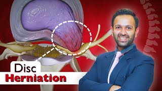 Disc Herniation Explained Causes Symptoms Diagnosis amp Best Treatment Options [upl. by Ahsiea335]