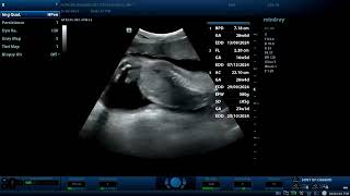 Achondroplasia ultrasound findings Diagnostic ultrasound cases [upl. by Cheyne]