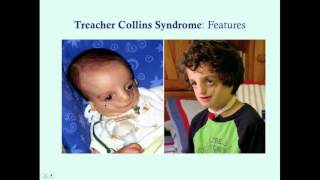 Treacher Collins Syndrome  CRASH Medical Review Series [upl. by Itsud]