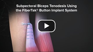 Subpectoral Biceps Tenodesis Using the FiberTak® Button Implant System [upl. by Pyle]