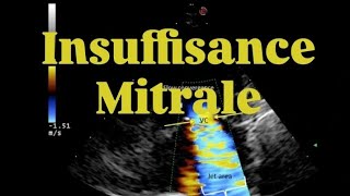 🫀INSUFFISANCE MITRALE [upl. by Dulcie705]