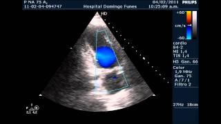 Insuficiencia Coronaria y Miocardiopatia Hipertrofica Septal Primariawmv [upl. by Wachtel]