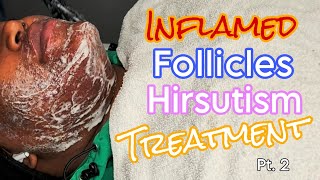 Inflamed Follicles Hirsutism Treatment Skincare wextractions pt 2 FOLLOWUP [upl. by Htrahddis406]