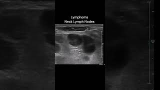 Neck Lymph Nodes  3 ultrasound imaging cases lymphoma [upl. by Stinson]