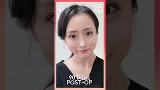 SHORTS Ptosis Correction Double Eyelid Surgery and Upper Eyelid Fat Grafting Recovery and Results [upl. by Rosabelle]