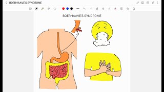 BOERHAAVES SYNDROME [upl. by Aehsrop]