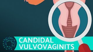 What Is Vaginitis  VULVOVAGINITIS [upl. by Bena]