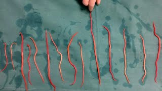 Doctors Remove 14 Roundworms From Woman [upl. by Rennie]