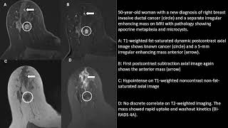 Fibrocystic Changes of the Breast Radiologic–Pathologic Correlation of MRI [upl. by Lissi]