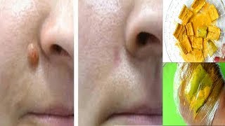 Just 1 Single Night Remove Skin Tag Mole And Wart Fast With Skin Tag Treatment [upl. by Yelrac868]