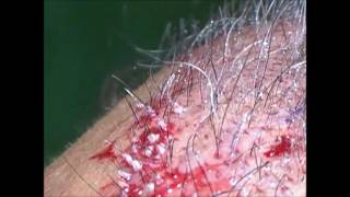 Fixing a pluggy hairline with hair transplant by Dr Lindsey  McLean  VA  MD  DC  Virginia [upl. by Hochman]