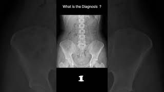 Normal  with faeces Abdominal Xray  Abnormalities  Normal reference 61 radiologychannel007 [upl. by Loram]