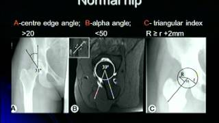 Femoroacetabular Impingement [upl. by Ainoyek261]