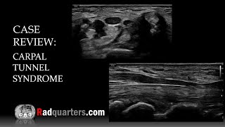 Ultrasound of Carpal Tunnel Syndrome [upl. by Arahsak]