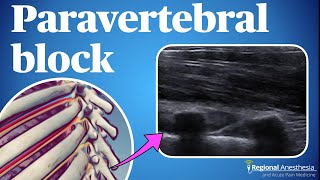 Ultrasound guided thoracic paravertebral block [upl. by Eitsirc]