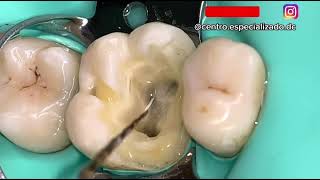 ¡Endodoncia en diente real [upl. by Amla855]