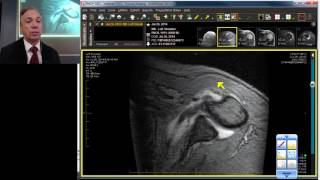 MRI Case Review Shoulder Deep Dive [upl. by Nirrep197]