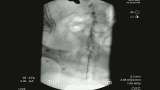 Fluoroscopic Caudal Epidural Contrast Spread [upl. by Panthia]