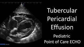 Tubercular Pericardial Effusion  Point of Care ECHO  Short Video [upl. by Carine]