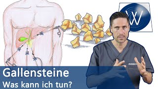 Gallensteine Was nun Typische Symptome Alles zur Entstehung amp Tipps zur natürlichen Entfernung [upl. by Leiram]