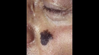 Squamous Cell Carcinoma and Lentigo Maligna Melanoma plus the precancerous conditions [upl. by Nylssej]