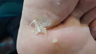 Warts Remove treatment 1st visit to last visitsatisfying footcomfort footcare footcallous foot [upl. by Carmena]