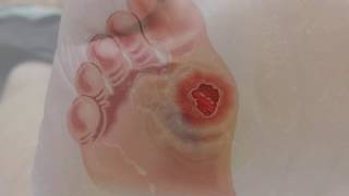 Why foot care so important when people have diabetes   Best Diabetes Info Channel [upl. by Acinhoj]