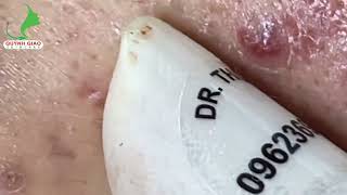 Satisfying SkinCare Blackheads Acne Extraction Video With Dr Thuy QGSPA Date Nov122024 [upl. by Nede798]