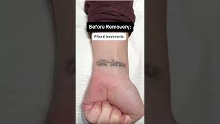 Before amp After Tattoo Removal at Removery😍 [upl. by Delaryd]