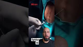 Colocación de catéter epidural [upl. by Morly]