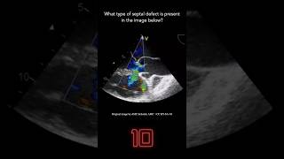 Echocardiography Question 12 [upl. by Barbuto]