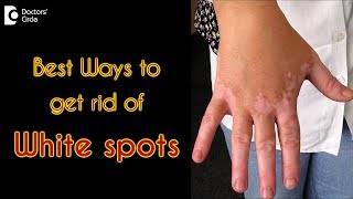 How to treat white spots on the skin  Dr Rasya Dixit [upl. by Karee]