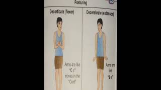 ICP  Posturing  Decorticate Flexesor  Decerebrate Extender posturing brain headinjury [upl. by Amice]