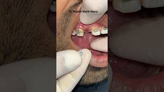 Temporary Teeth Replacement During Braces Treatment  Dr Rajesh Malik braces shortsfeed [upl. by Ress]