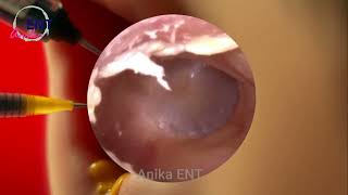 Ear Wax Removal Doctors Secret to CLEAR Ears [upl. by Hanway]