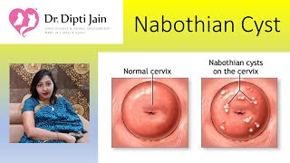 Nabothian cysts HINDI [upl. by Airdnna]