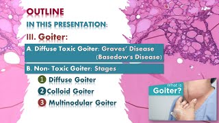 Goiter Graves disease multinodular goiter Thyroid lecture شرح محاضرة [upl. by Kcorb]