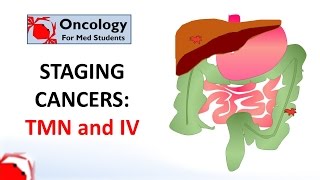 Staging cancers TNM and IIV systems [upl. by Byers447]