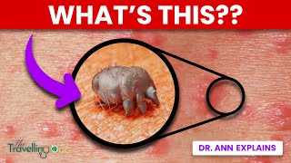 Scabies  WARNING Doctor explains Causes Symptoms and Treatments [upl. by Drofiar728]