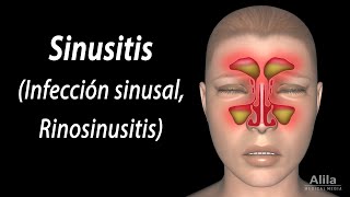 Sinusitis Animación Alila Medical Media Español [upl. by Selina]