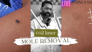 co2 laser mole removal scarlesssurgery painlesssurgery co2laser skincare scarremoval video [upl. by Charmane]