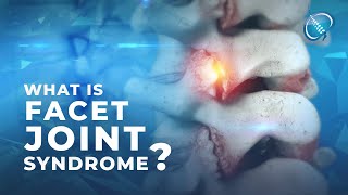 What is Facet Joint Syndrome [upl. by Romito]