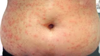 Miliaria Heat Rash  All 3 types  How to treat [upl. by Michiko]