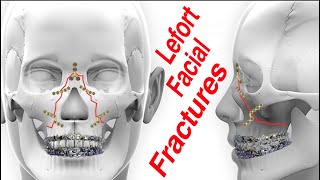 Lefort 13 Upper Jaw MidFace Facial Fractures [upl. by Cheffetz]