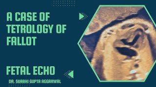 Tetrology of Fallot  Fetal echocardiography  Dr Surbhi Gupta Aggarwal [upl. by Ahsyle]