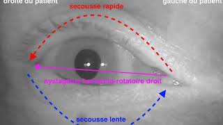 Nystagmus horizontorotatoire droit lors de la manœuvre diagnostique de DixHallpike VPPB 4ème [upl. by Rogergcam]