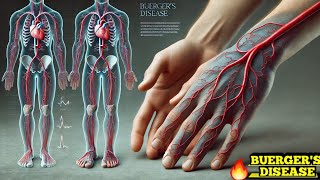 Buergers Disease Thromboangiitis Obliterans Easy Explanation [upl. by Aipotu83]