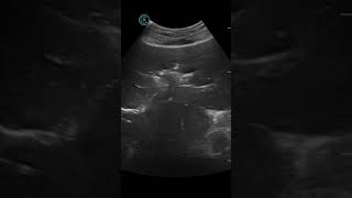 Pneumobilia post ERCP with stent Apache [upl. by Germin]