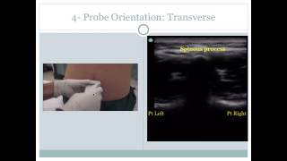 Ultrasound Guided Lumbar Puncture [upl. by Diarmid]